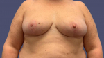 Breast Reduction 8 After